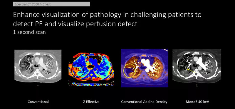 Система компьютерной томографии Philips Spectral CT 7500